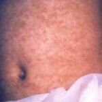 U.S. TRUST IN MEASLES VACCINE FALLS AS OUTBREAK REACHES HIGHEST LEVEL IN DECADES