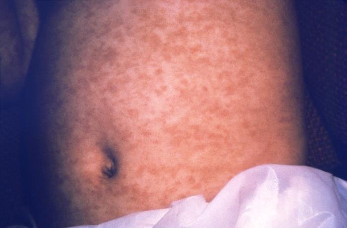 U.S. TRUST IN MEASLES VACCINE FALLS AS OUTBREAK REACHES HIGHEST LEVEL IN DECADES